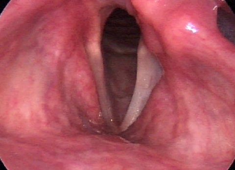 Stimmchirurgie-Allgemeine-Info