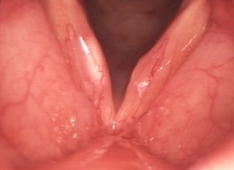 Stimmchirurgie-Allgemeine-Information