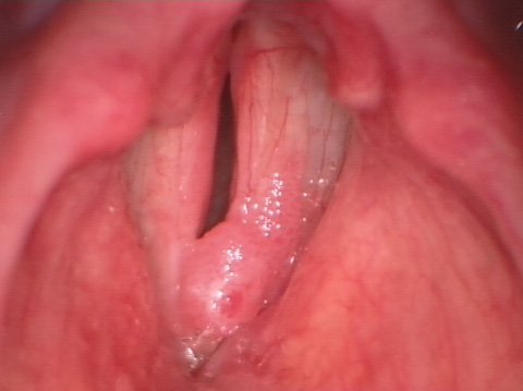 Laryngeal papillomatosis before surgery Laryngeal papillomatosis