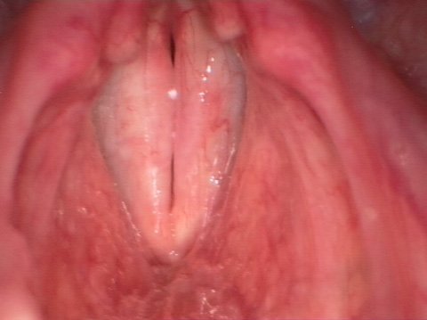 Laryngeal papillomatosis after surgery