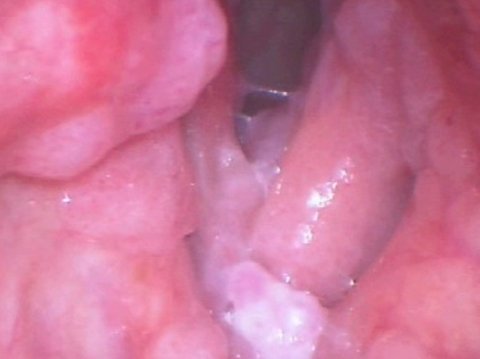 Extensive papillomatosis