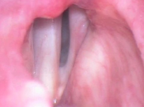 Vocal folds before fat augmentation