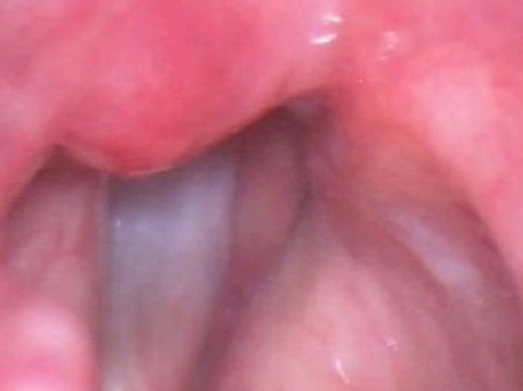 Vocal folds after fat augmentation