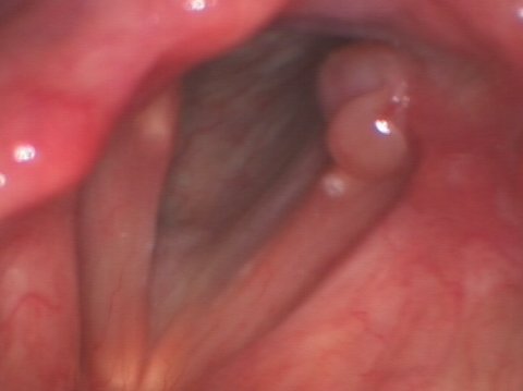 Medium-sized contact granuloma contact granuloma