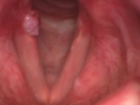 Medium-sized contact granuloma contact granuloma