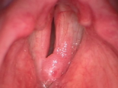 Medium-sized vocal papilloma vocal papilloma