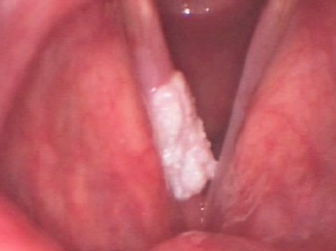 Squamous cell carcinoma of the vocal fold carcinoma of the vocal fold