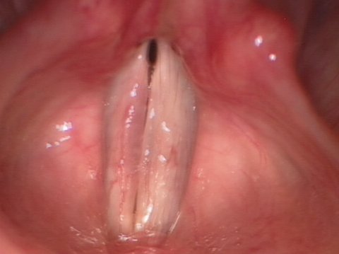 Reinke's edema after surgery