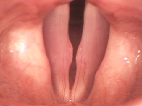 vocal cord nodules