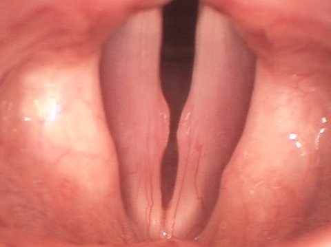 Larger vocal cord nodules vocal cord nodules