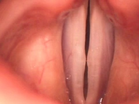 Smaller-sized vocal cord nodules vocal cord nodules