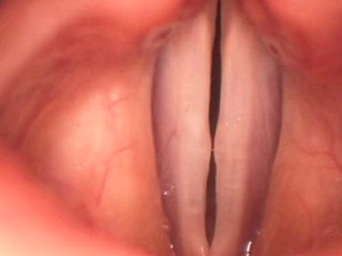 vocal cord nodules