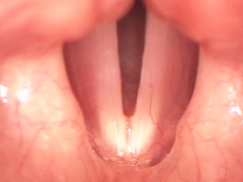 Vocal cord nodules after surgery