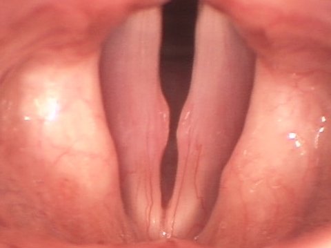 Vocal cord nodules