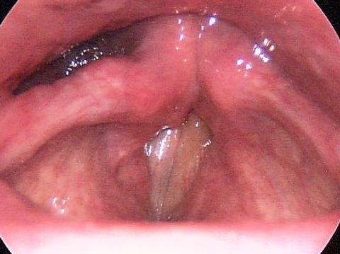 Vocal cord paralysis after surgery