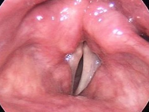 Vocal cord paralysis before surgery