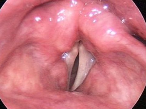 Paralyzed Vocal Cord During Phonation