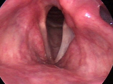 Vocal Cord Paralysis During Respiration