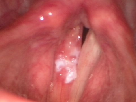Vocal cord leukoplakia before surgery Vocal cord leukoplakia