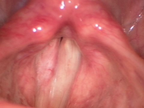 Vocal cord leukoplakia after surgery