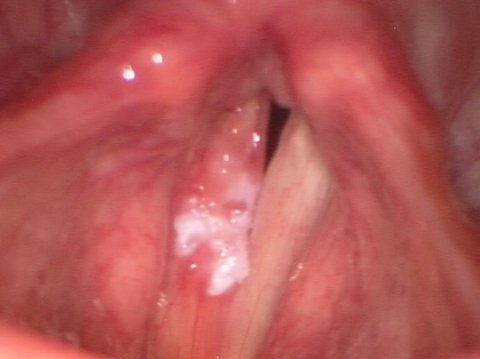 Vocal Cord Leukoplakia