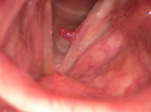 vocal cord polyp