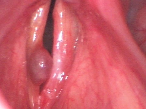hemorrhagic vocal cord polyp