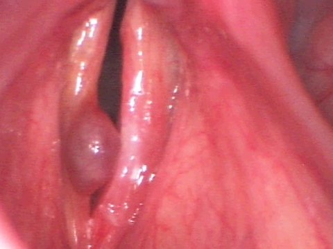 Large hemorrhagic vocal cord polyp hemorrhagic vocal cord polyp