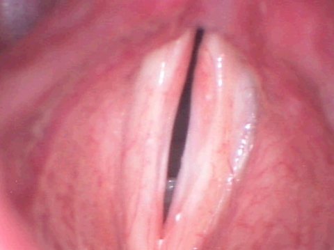 Vocal cord polyp after surgery