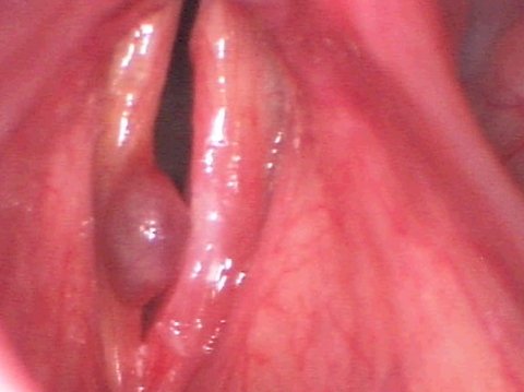 Vocal cord polyp before surgery