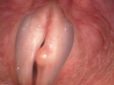 Medium-sized vocal cord cyst Medium-sized vocal cord cyst