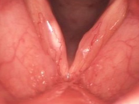 vocal fold cyst