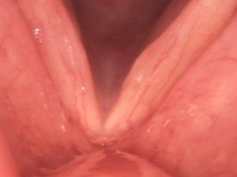 Vocal cord cyst after surgery