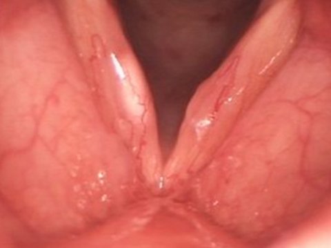 Vocal cord cyst before surgery