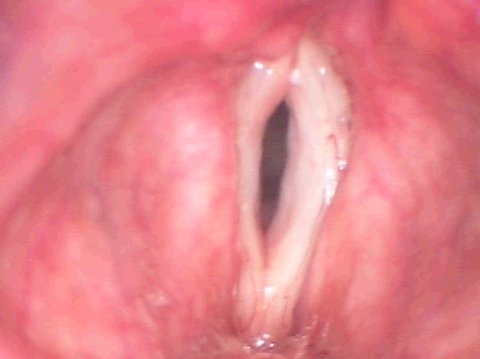 Vocal folds before anti-aging surgery