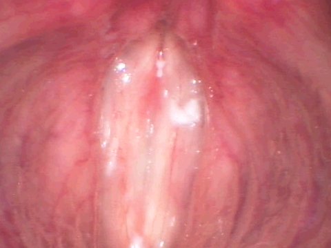 Vocal folds after anti-aging surgery
