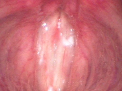 Vocal folds after anti-aging surgery Vocal folds after anti-aging surgery